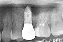府中市の歯医者 口腔外科専門医　武田歯科のインプラント事例【左上5（ソケットリフト）】上部構造装着
