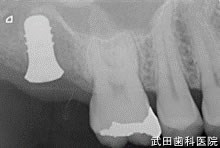 府中市の歯医者 口腔外科専門医　武田歯科のインプラント事例【右上7】インプラント埋入
